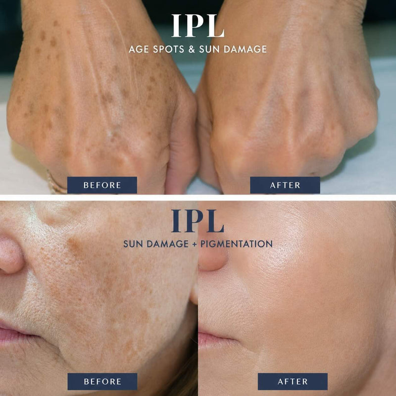 Before and after comparison of IPL treatment on skin for age spots, sun damage, and pigmentation.