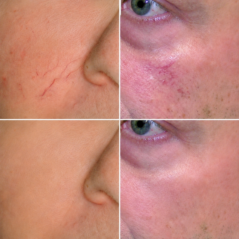 a before and after image of treatment for spider veins and red spots